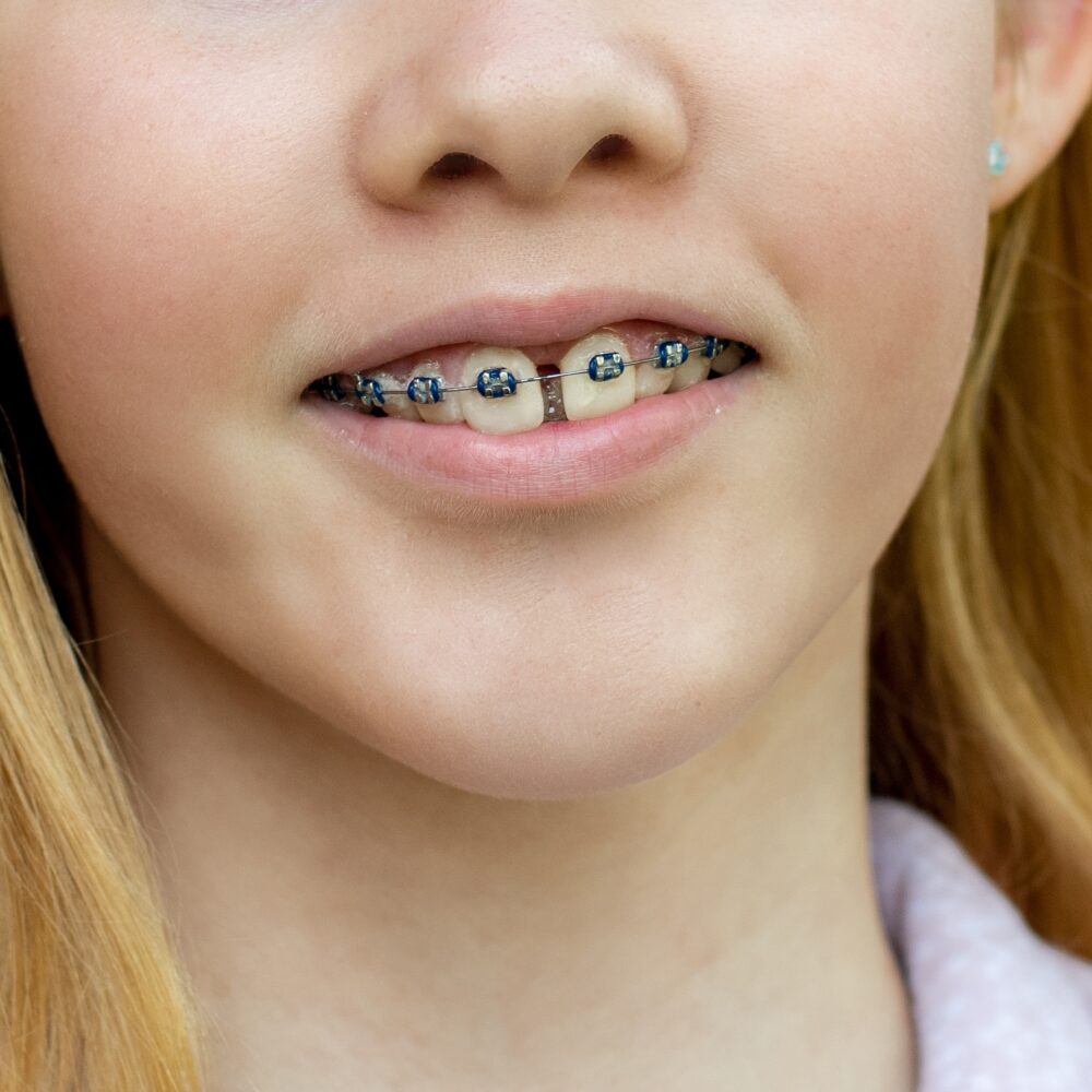 teenage-girl-wearing-metal-braces-orthodontic-den-2022-11-15-14-04-41-utc